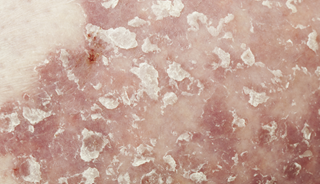 Tonsillectomy may improve psoriasis symptoms in select patients Tonsillectomy may improve psoriasis symptoms in select patients