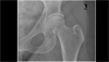 Ortho Dx: Dramatic, worsening hip pain Ortho Dx: Dramatic, worsening hip pain