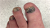 Derm Dx: Hyperpigmentation on fingers, fingernails, and lips Derm Dx: Hyperpigmentation on fingers, fingernails, and lips
