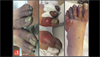 Image of the Week: Severe frostbite Image of the Week: Severe frostbite