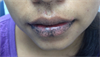 Derm Dx: Brown macules on the lips, fingers Derm Dx: Brown macules on the lips, fingers