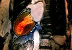 Is takotsubo cardiomyopathy in your differential diagnosis? Is takotsubo cardiomyopathy in your differential diagnosis?