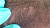 Derm Dx: Scaly spot on the scrotum Derm Dx: Scaly spot on the scrotum
