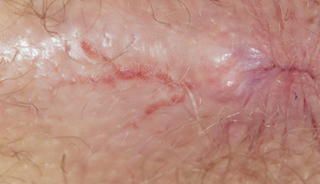 Itchy perianal erythema | The Journal of Family Practice