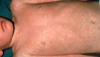 A case of measles on a child’s torso. A case of measles on a child’s torso.