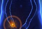 Antibiotics may be alternative
to appendectomy in some patients Antibiotics may be alternative
to appendectomy in some patients