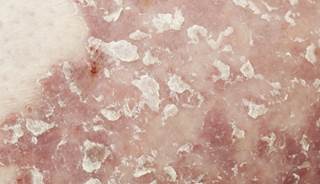 Guselkumab was more effective than adalimumab for psoriasis.