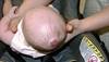 Derm Dx: Red, subcutaneous nodule on an infant's scalp Derm Dx: Red, subcutaneous nodule on an infant's scalp