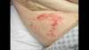 Derm Dx: A blistering rash on the abdomen, thighs Derm Dx: A blistering rash on the abdomen, thighs