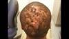 Derm Dx: Diffuse nodularity of the scalp Derm Dx: Diffuse nodularity of the scalp