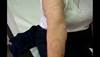 Derm Dx: Annular, erythematous patches Derm Dx: Annular, erythematous patches
