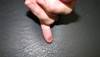 Derm Dx: Red papule following puncture by rose thorn Derm Dx: Red papule following puncture by rose thorn