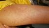Derm Dx: Asymptomatic dermatitis that feels like sandpaper Derm Dx: Asymptomatic dermatitis that feels like sandpaper