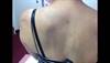 Derm Dx: Dark patches on the chin, trunk, arms, and thighs Derm Dx: Dark patches on the chin, trunk, arms, and thighs