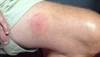 Derm Dx: Rash that the patient suspects is Lyme disease Derm Dx: Rash that the patient suspects is Lyme disease