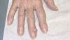 Derm Dx: Semi-translucent tumor on the finger Derm Dx: Semi-translucent tumor on the finger