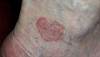 Derm Dx: Erythematous, annular patch with atrophic center Derm Dx: Erythematous, annular patch with atrophic center