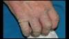 Derm Dx: Crusting and scaling of the skin in a nursing home resident Derm Dx: Crusting and scaling of the skin in a nursing home resident