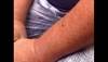 Derm Dx: Hyperkeratotic central plaque on the arm Derm Dx: Hyperkeratotic central plaque on the arm