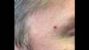 Derm Dx: Traumatized erythematous papule above the eyebrow Derm Dx: Traumatized erythematous papule above the eyebrow