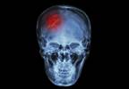 High stress jobs are linked to increased stroke risk High stress jobs are linked to increased stroke risk