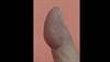 Derm Dx: Mass under the skin of the index finger Derm Dx: Mass under the skin of the index finger