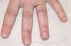 Derm Dx: Red lesions on the interphalangeal joints of the hands Derm Dx: Red lesions on the interphalangeal joints of the hands