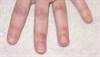 Additional Tool for Juvenile Dermatomyositis Diagnosis: Muscle MRI Additional Tool for Juvenile Dermatomyositis Diagnosis: Muscle MRI