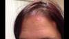 Derm Dx: Erythematous patches and plaques on a woman's forehead Derm Dx: Erythematous patches and plaques on a woman's forehead