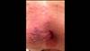 Derm Dx: Rectal rash preceded by pain in an elderly man Derm Dx: Rectal rash preceded by pain in an elderly man