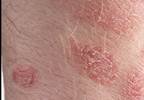 PALACE 1 study confirms safety, efficacy of apremilast for psoriatic arthritis PALACE 1 study confirms safety, efficacy of apremilast for psoriatic arthritis