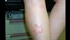 Derm Dx: Erythematous, indurated, follicular dermatitis on the shin Derm Dx: Erythematous, indurated, follicular dermatitis on the shin