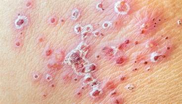 Shingles increases stroke, MI risk in elderly Shingles increases stroke, MI risk in elderly