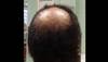 Derm Dx: Mid-scalp alopecia in a woman Derm Dx: Mid-scalp alopecia in a woman