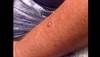 Derm Dx: Cystic nodule on a man's forearm Derm Dx: Cystic nodule on a man's forearm