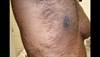 Derm Dx: Trunk dermatitis that does not fluoresce under Wood's light Derm Dx: Trunk dermatitis that does not fluoresce under Wood's light
