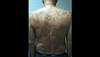 Derm Dx: Widespread salmon-colored patches Derm Dx: Widespread salmon-colored patches