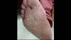 Derm Dx: Hyperkeratotic lesions of the palms and soles Derm Dx: Hyperkeratotic lesions of the palms and soles
