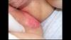 Derm Dx: A well-demarcated erythematous patch Derm Dx: A well-demarcated erythematous patch