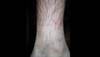 Derm Dx: A pruritic eruption on the ankles Derm Dx: A pruritic eruption on the ankles