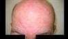 Derm Dx: Refractory dermatitis in a man on chemotherapy Derm Dx: Refractory dermatitis in a man on chemotherapy