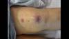 Derm Dx: Erythematous nodules after heart transplant Derm Dx: Erythematous nodules after heart transplant