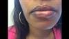 Derm Dx: Pruritic hyperpigmentation of the lips Derm Dx: Pruritic hyperpigmentation of the lips