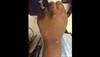 Derm Dx: Intensely itchy purple papules Derm Dx: Intensely itchy purple papules