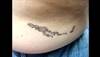 Derm Dx: Warty plaques in a unilateral pattern Derm Dx: Warty plaques in a unilateral pattern