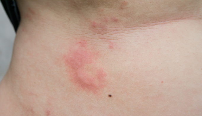 Omalizumab Effectively Treats Chronic Spontaneous Hives The Clinical Advisor