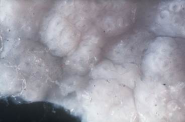 Celiac disease Celiac disease