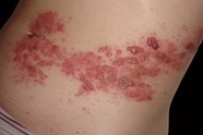 Shingles A Complete Guide For Clinicians The Clinical Advisor