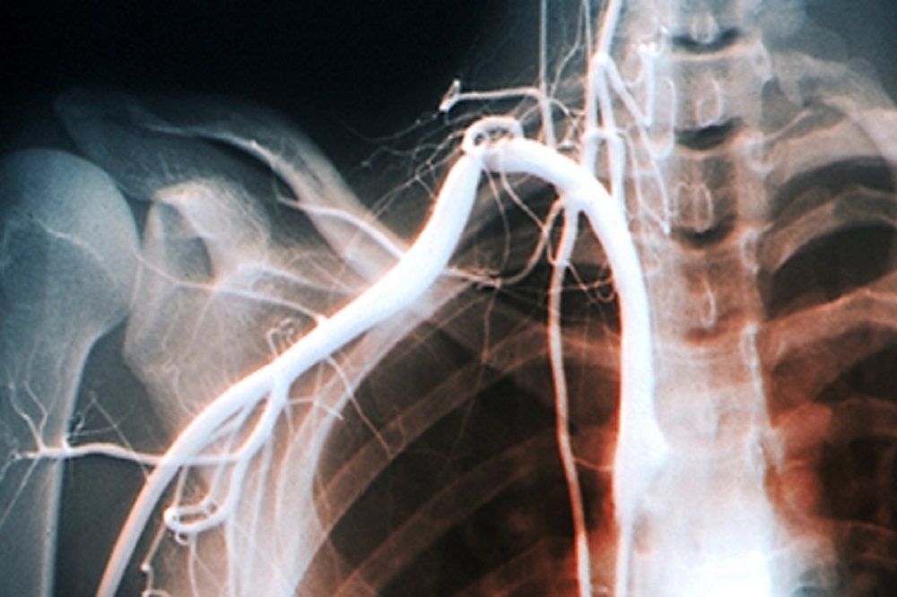 thoracic outlet syndrome