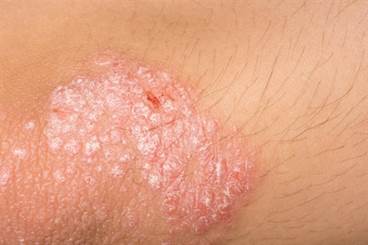 Cardiometabolic comorbidity rates high in psoriasis patients Cardiometabolic comorbidity rates high in psoriasis patients